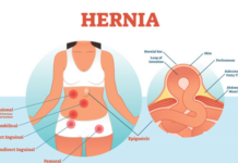 How Safe Is Hernia Surgery in Singapore? What Patients Should Know